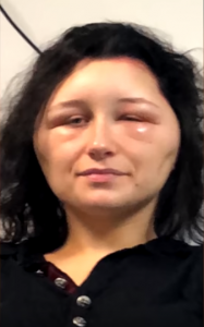 alergia-2