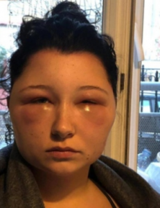 alergia-3